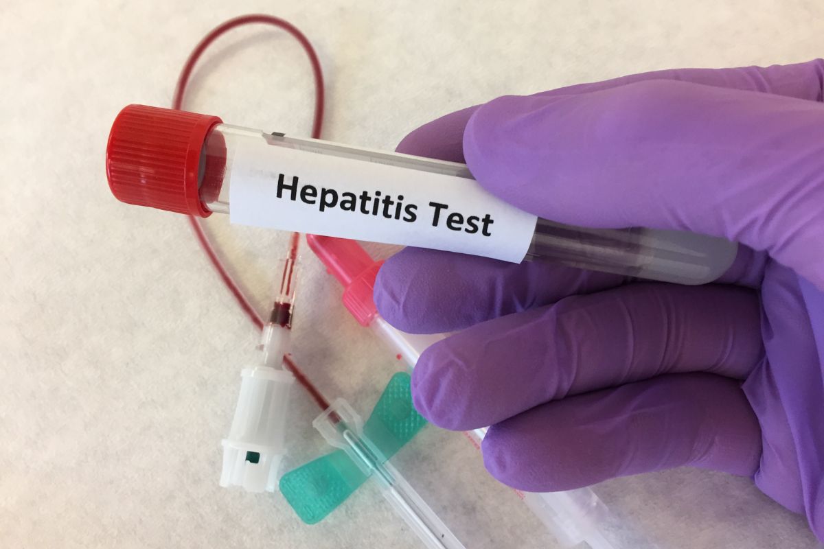   Hepatitis A, IgM Antibody