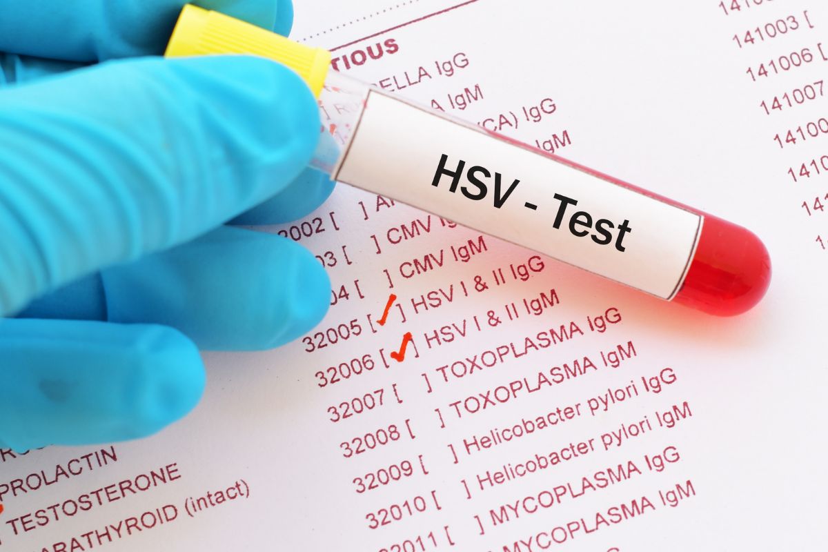   Herpes Simplex Virus- 1 IgM