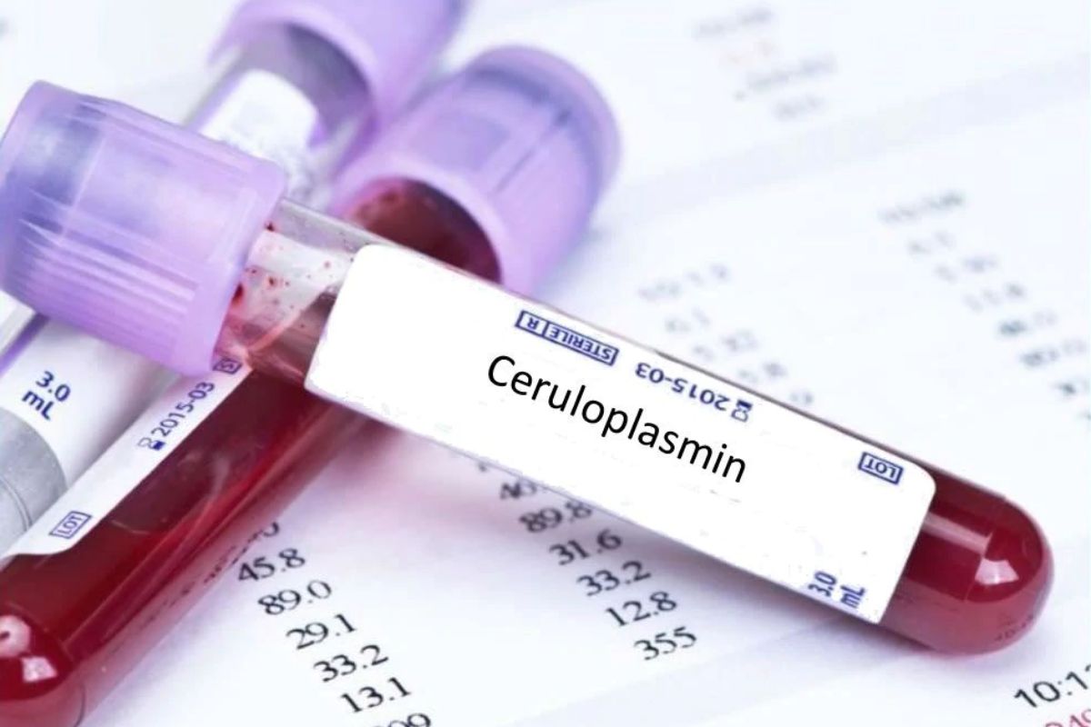   Ceruloplasmin