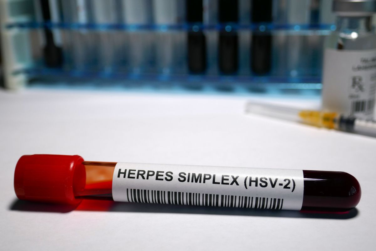   Herpes Simplex Virus-2 IgM