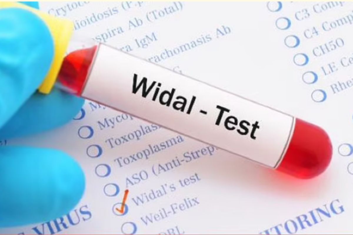   Widal Test