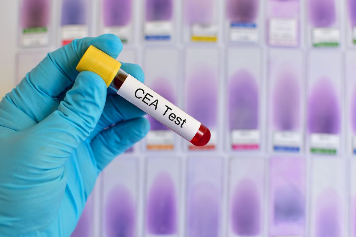 Carcinoembryonic Antigen (CEA)