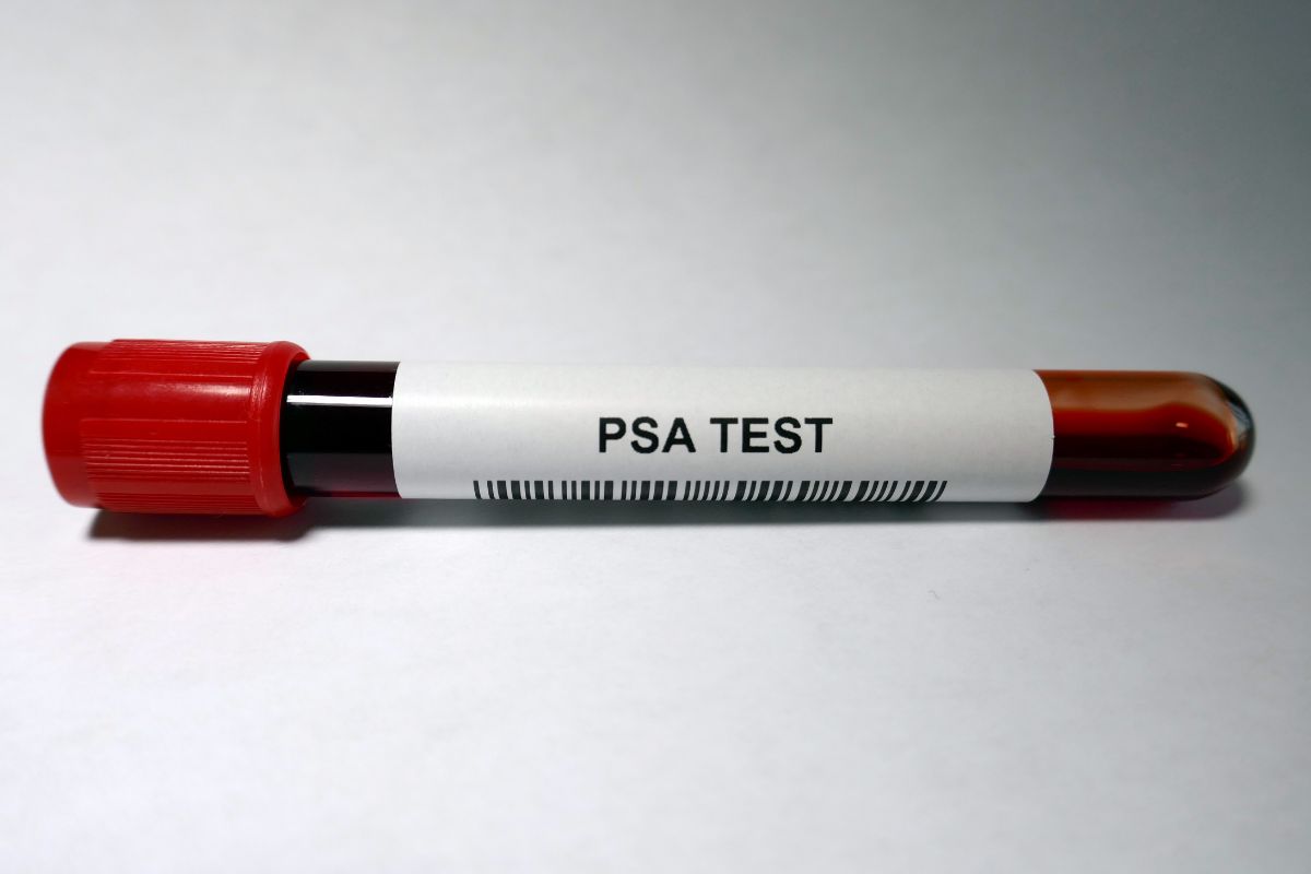 Prostate Specific Antigen (PSA Total)