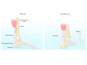 Achilles Tendinitis