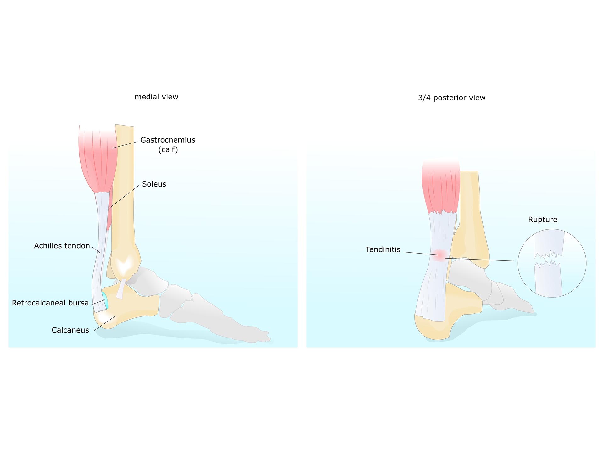 Achilles Tendinitis