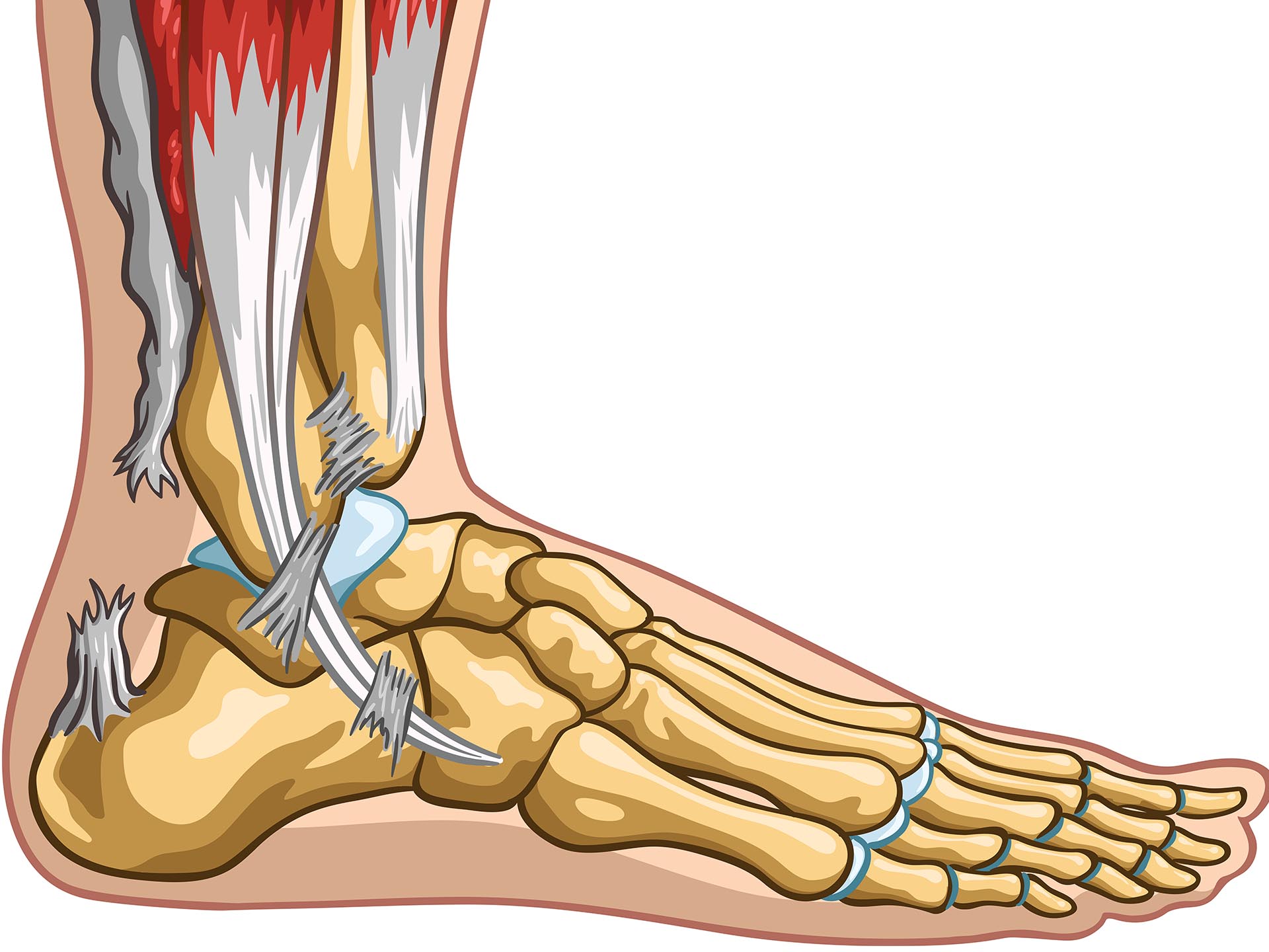 Achilles Tendon Rupture