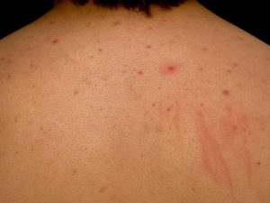 Acne Urticata