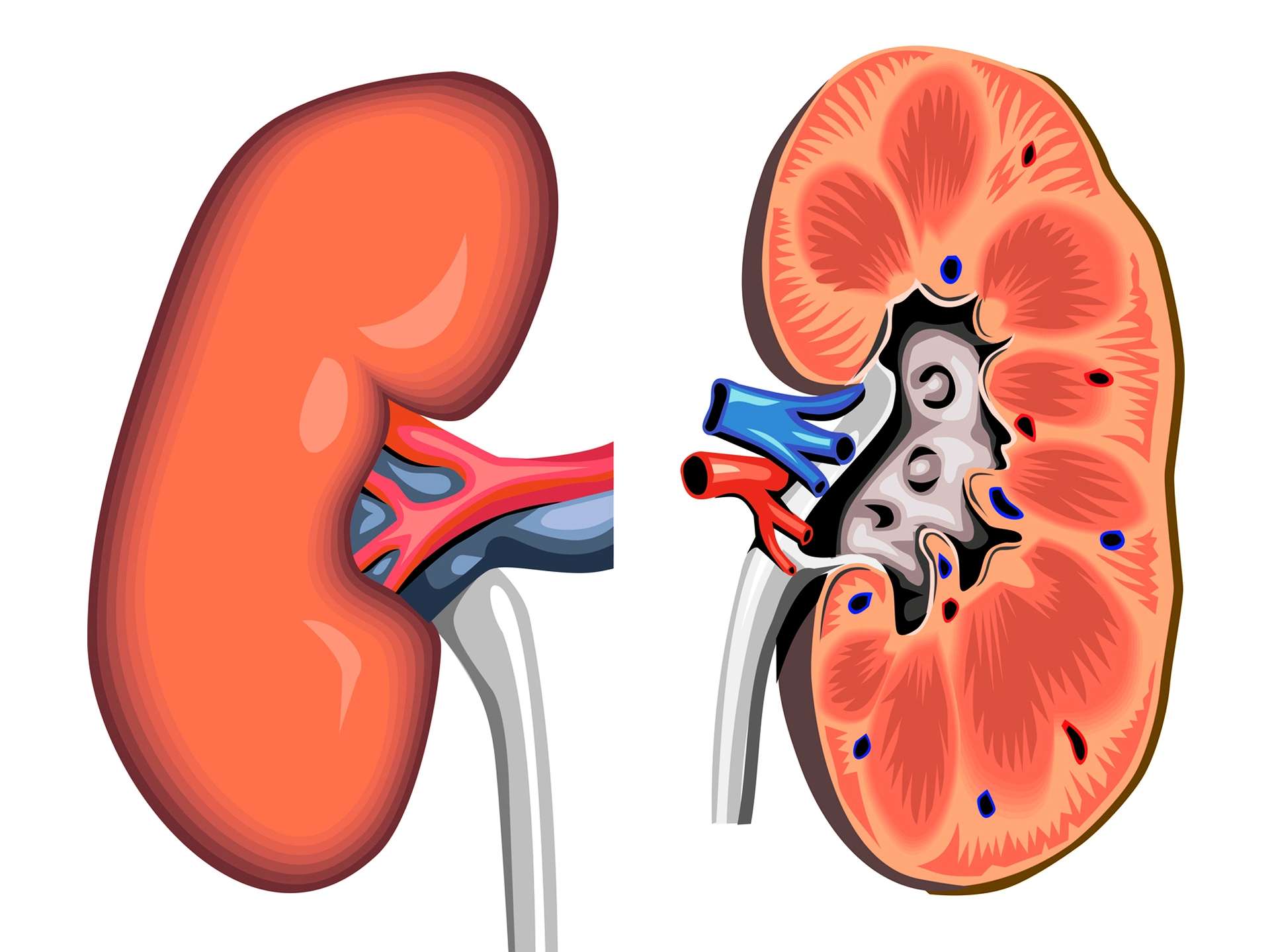 Acute kidney failure