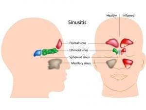 Acute sinusitis