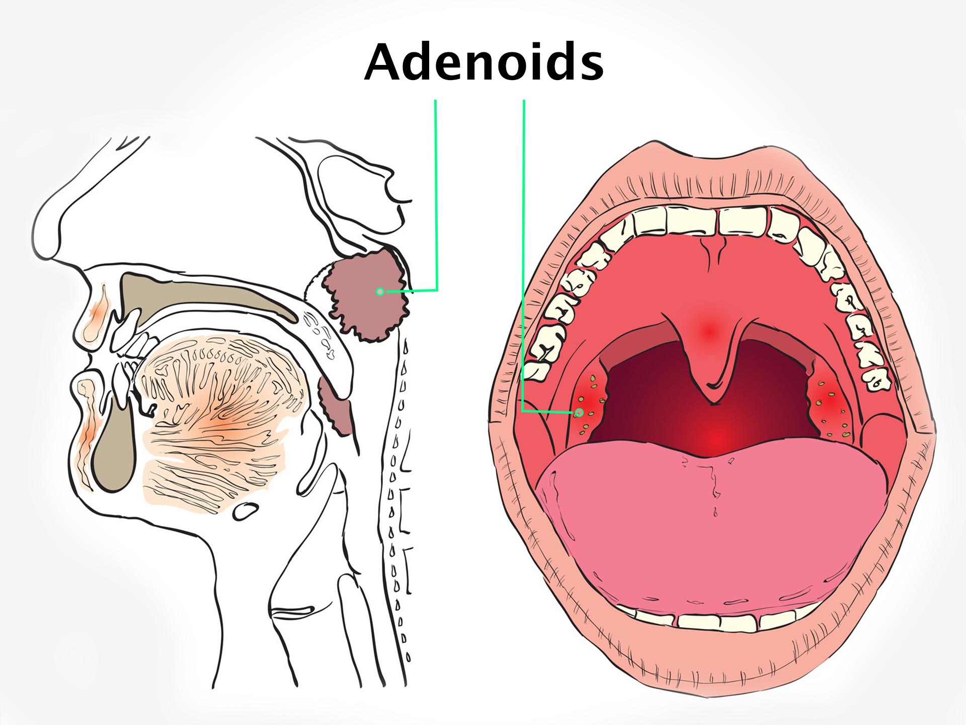 ADENOIDS