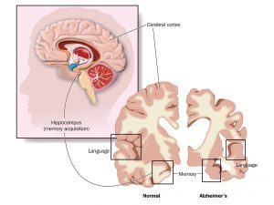 Alzheimer’s disease