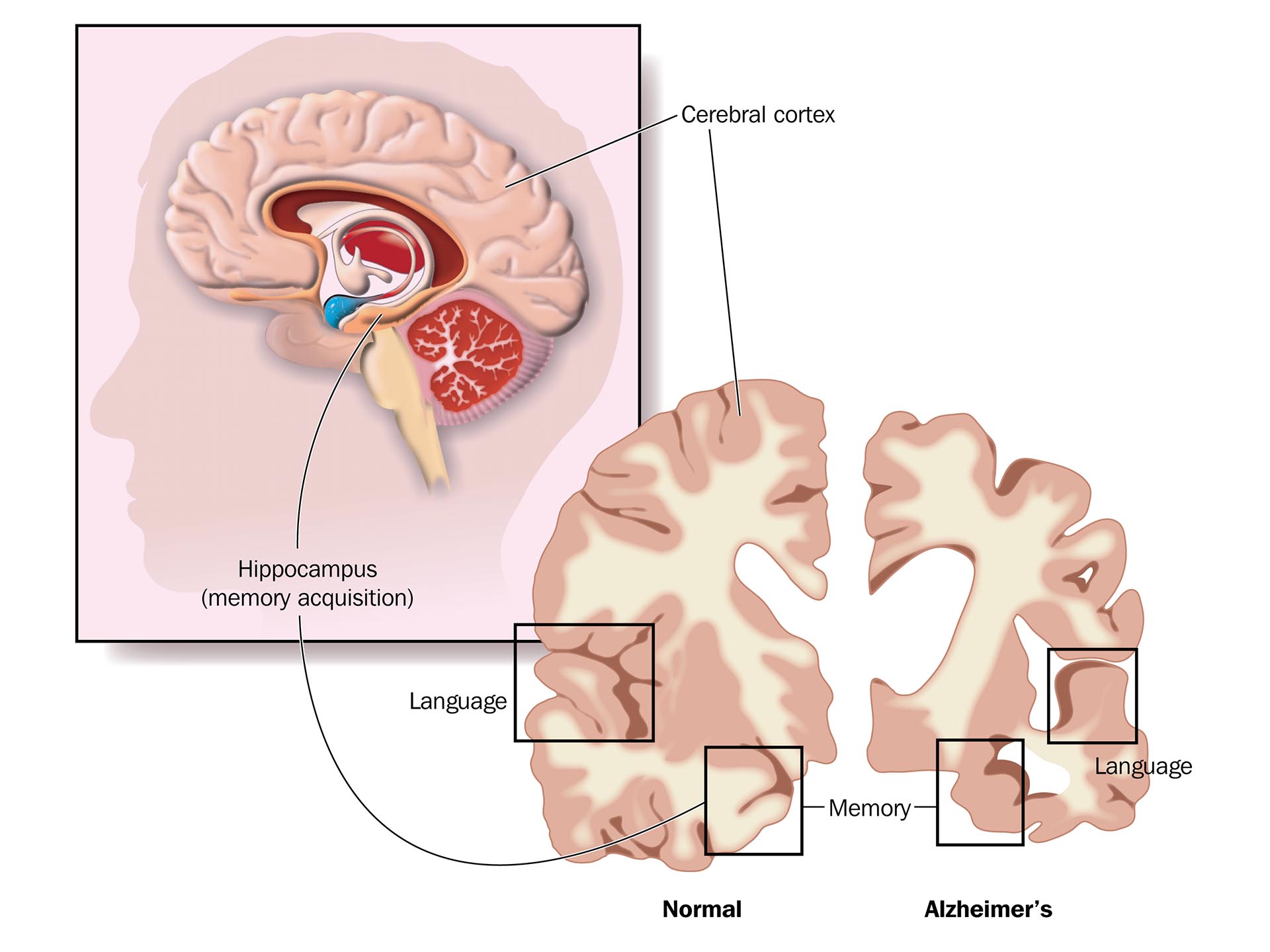 Alzheimer’s disease