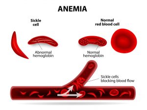 Anemia