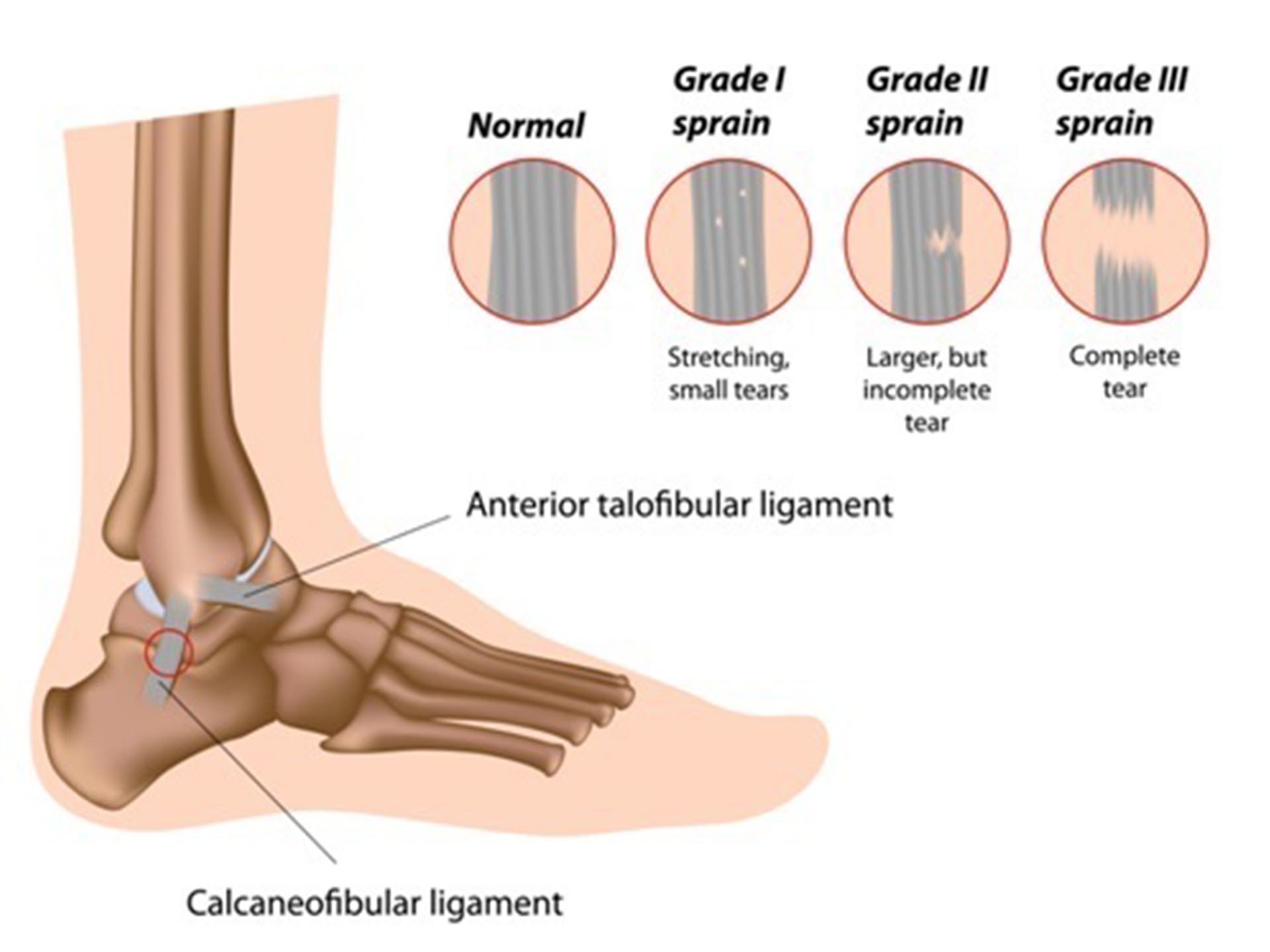 Ankle Sprain