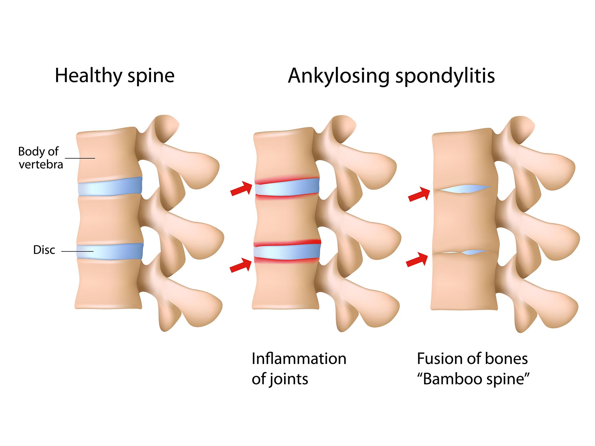 Ankylosing spondylitis