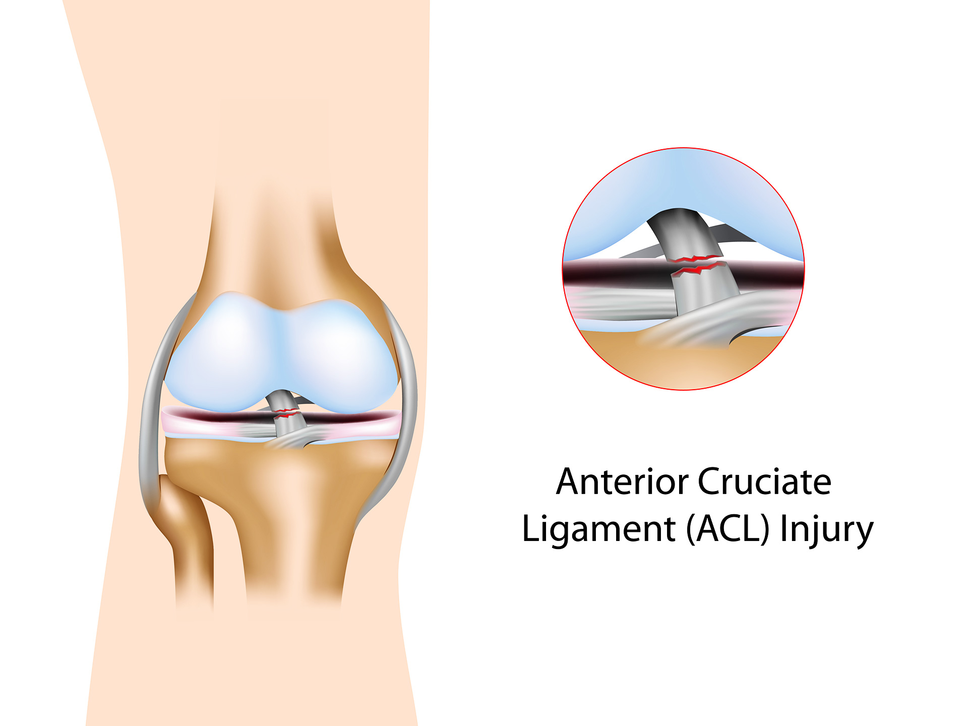 Anterior cruciate ligament injury