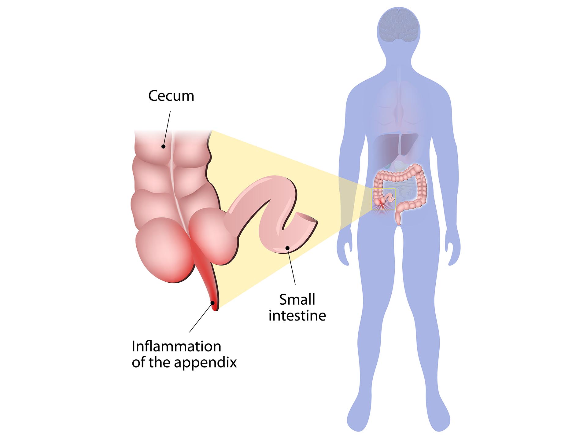 Appendicitis