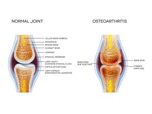 Arthritis