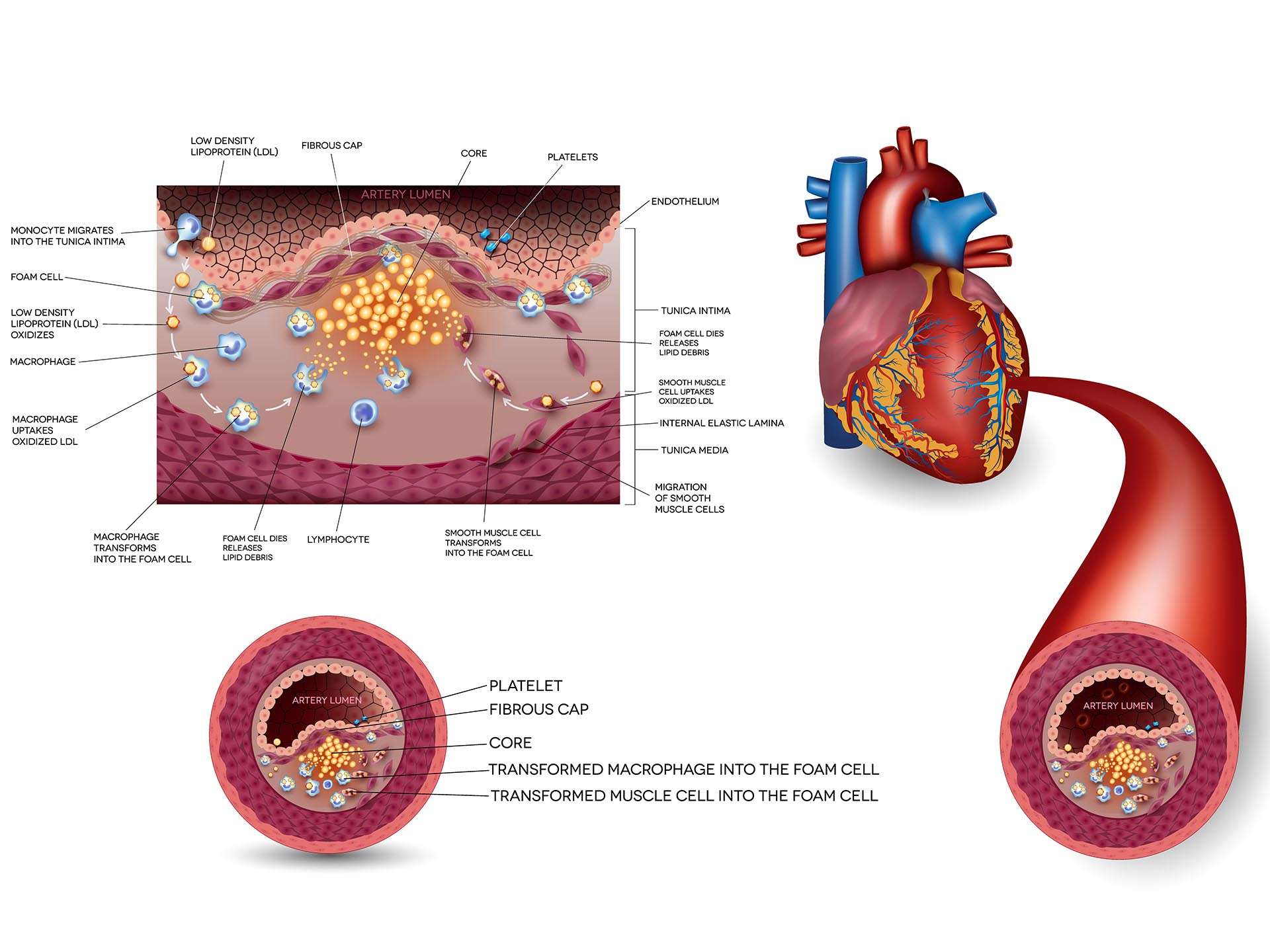 Atherosclerosis