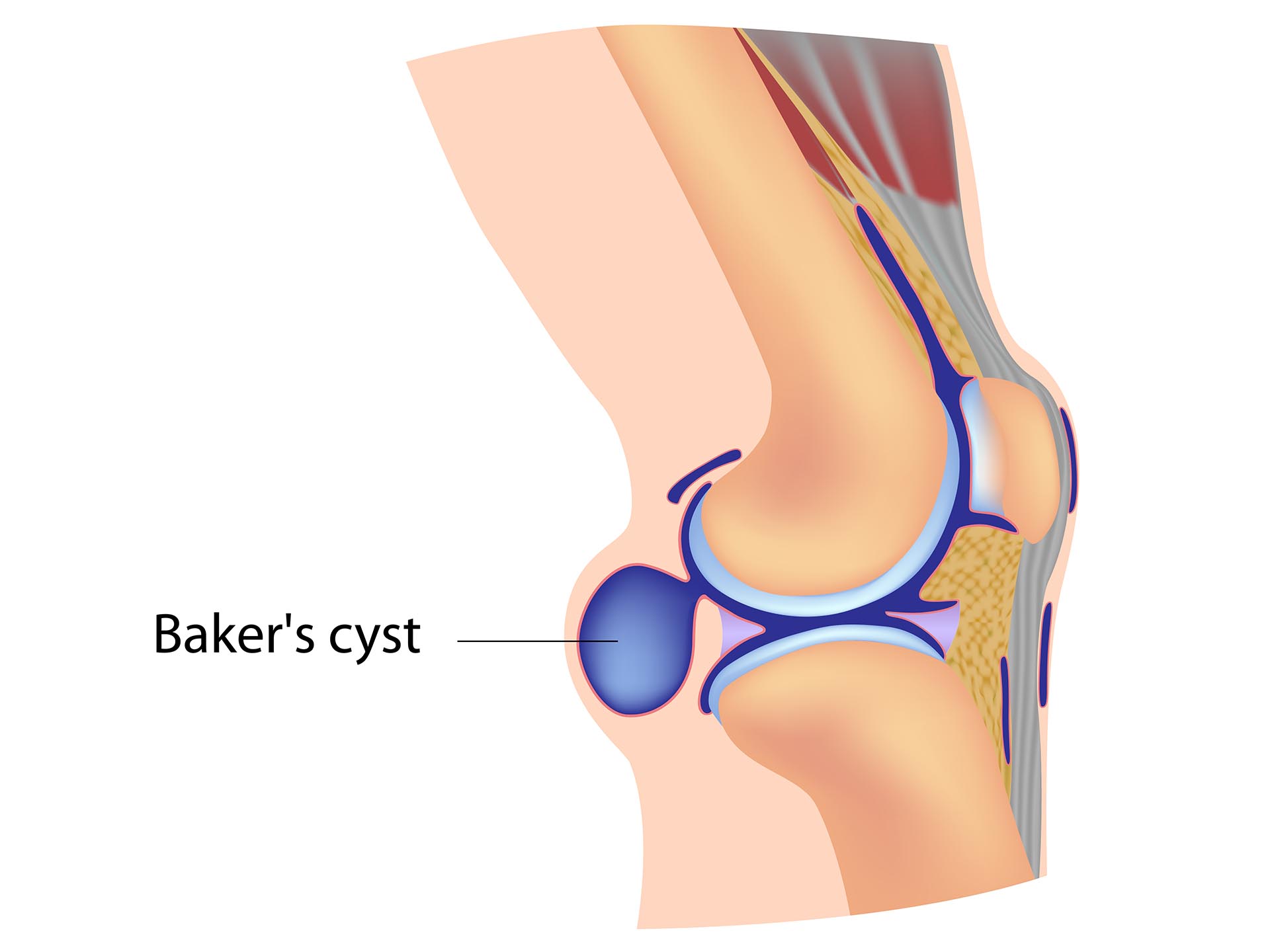 Baker’s cyst