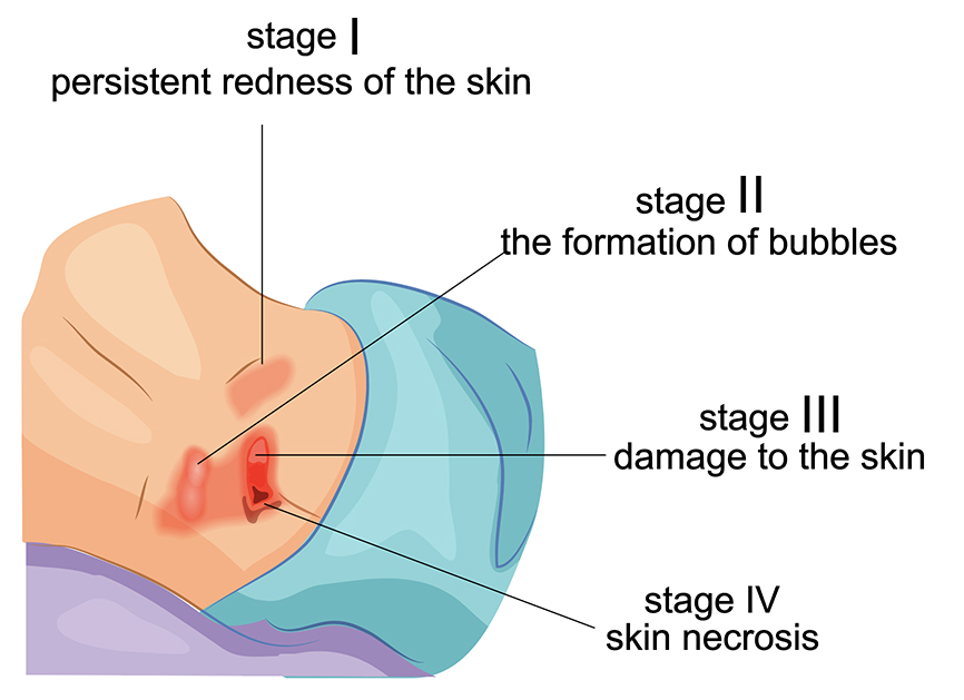 Bedsores (decubitus ulcers, Pressure ulcers)