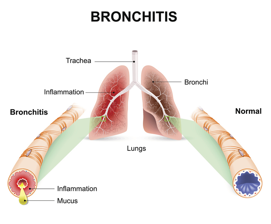 Bronchitis