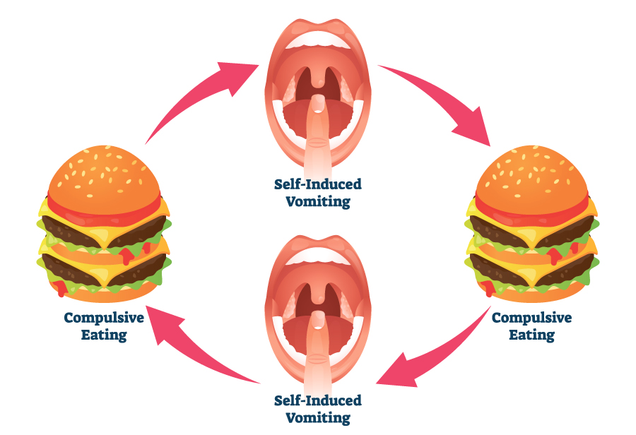 Bulimia nervosa