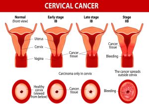 Cervical cancer