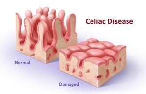 Coeliac Disease