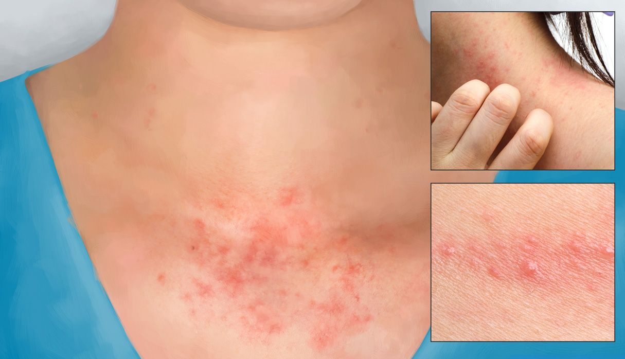 Contact dermatitis