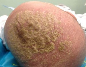 Cradle cap