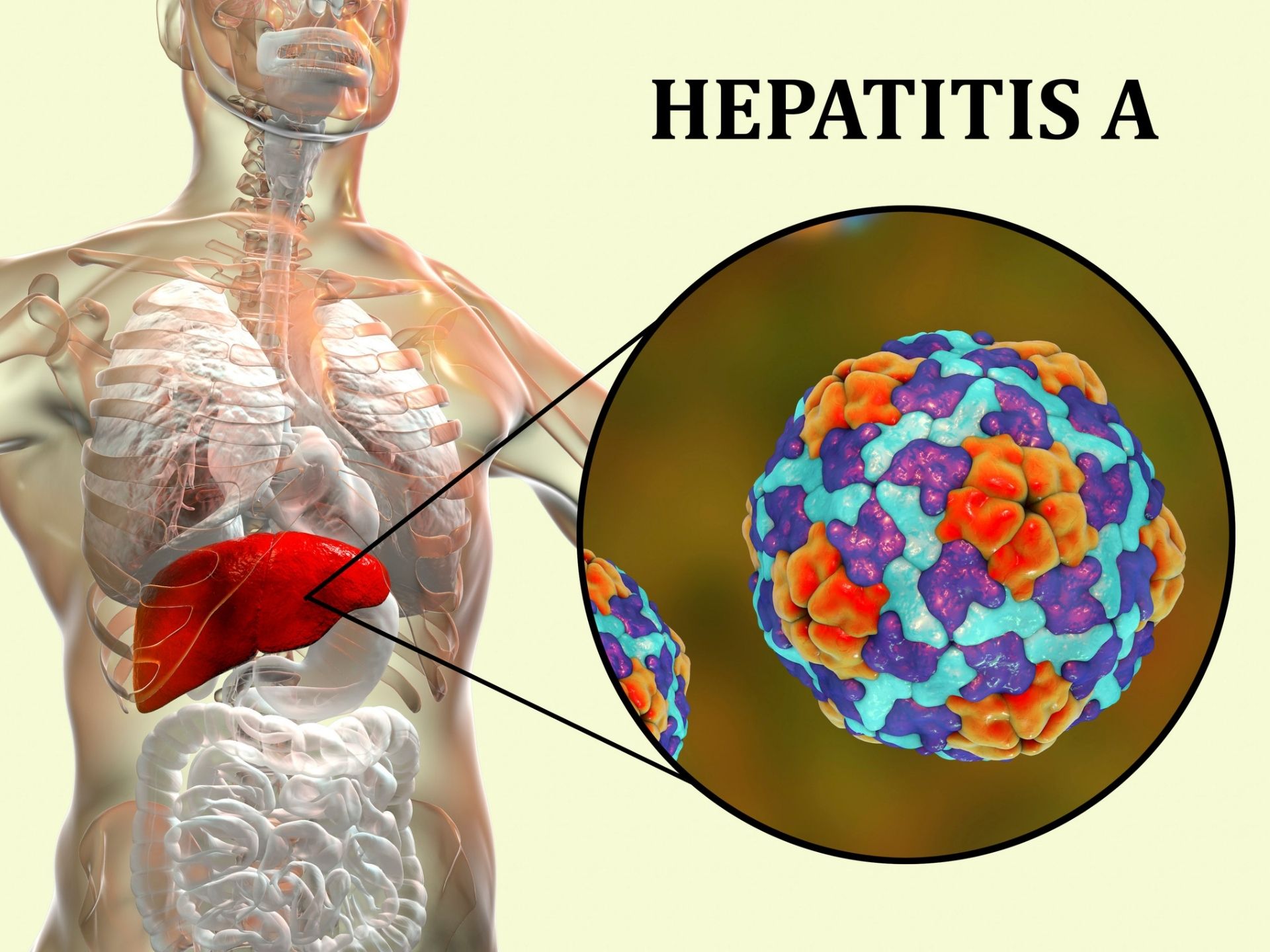 Hepatitis A