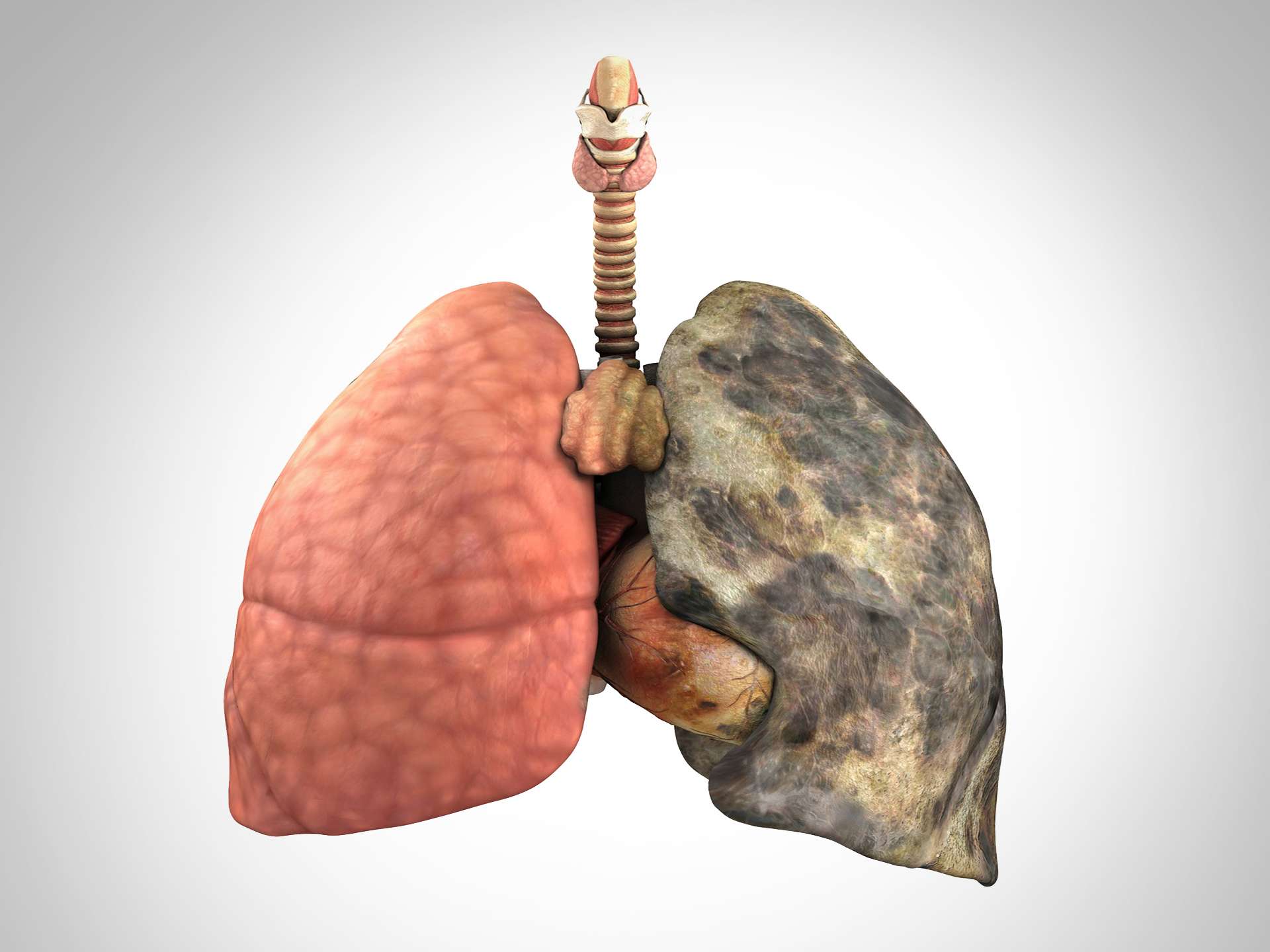 Emphysema