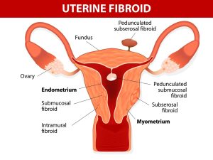 Endometrial Cancer