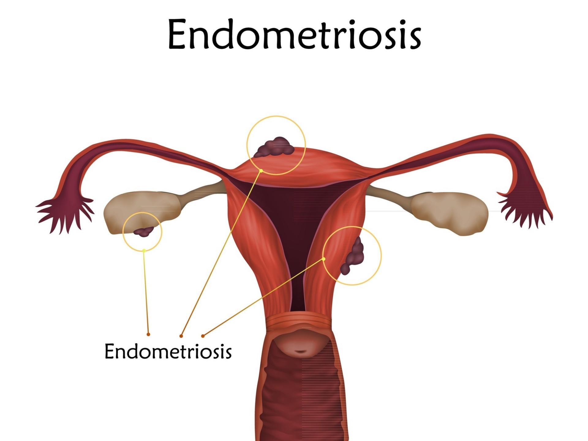 Endometriosis