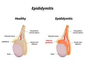 Epididymitis