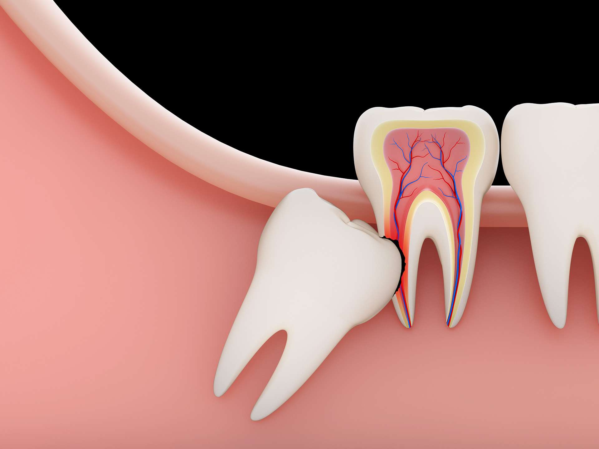 Erosion of teeth