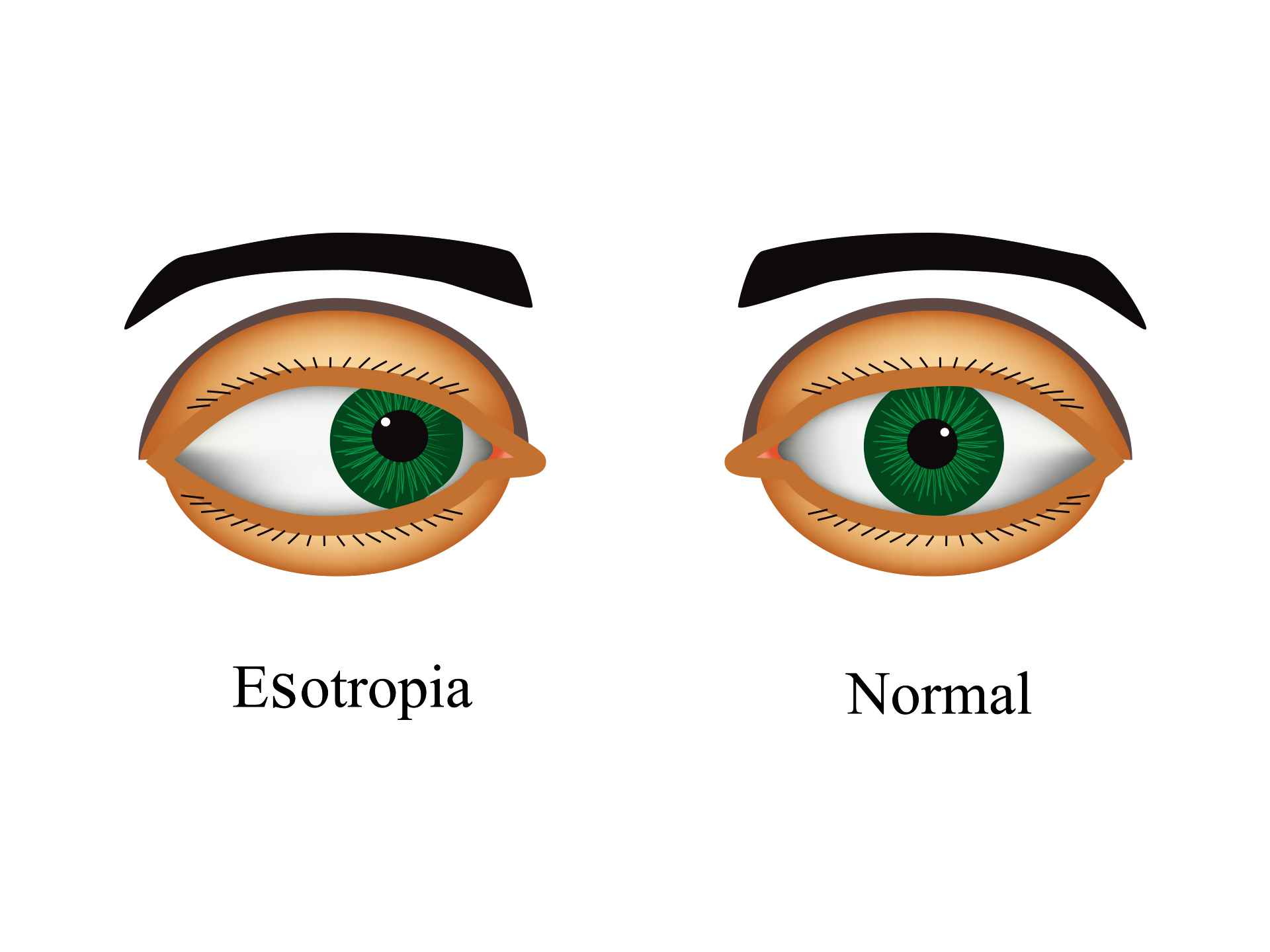 Esotropia