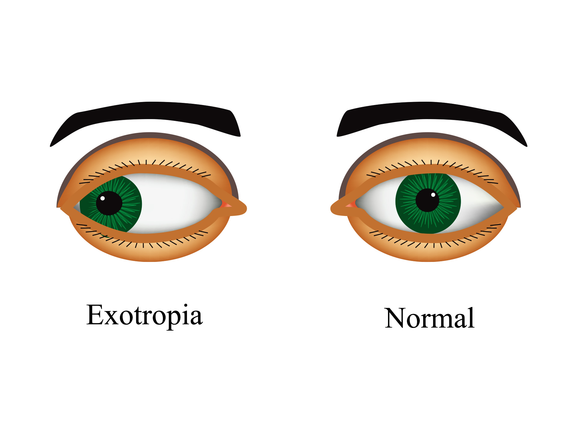 Exotropia