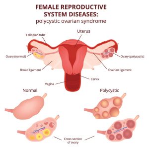 Female Infertility