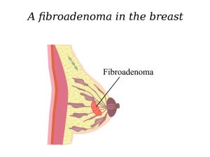 Fibro adenoma of breast