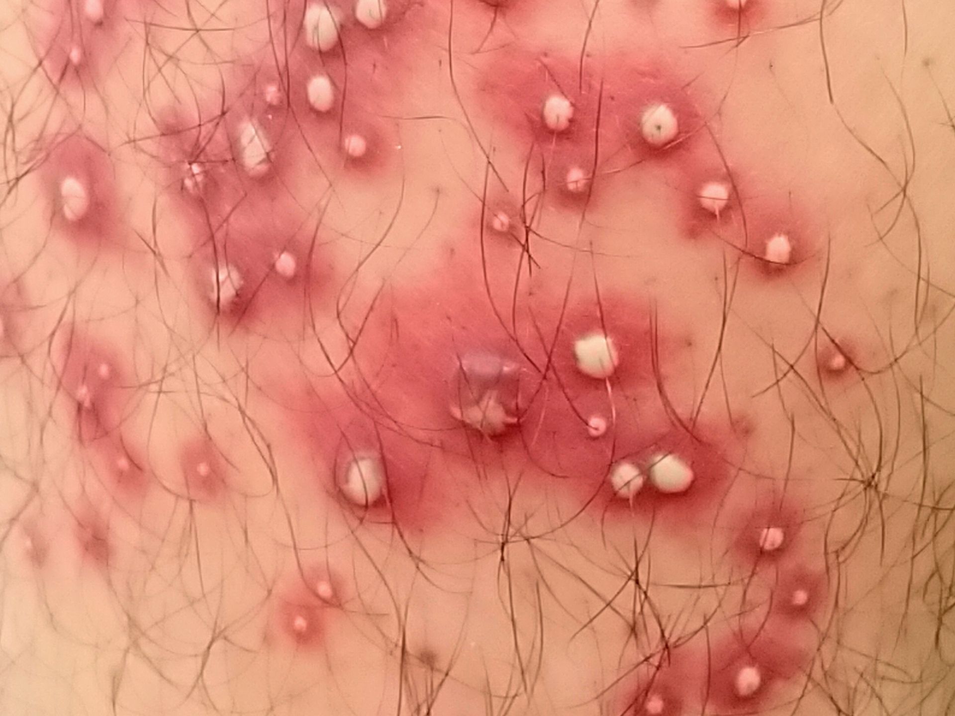 Folliculitis