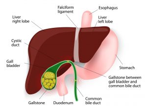 Gallstones