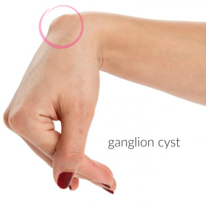 Ganglion cysts