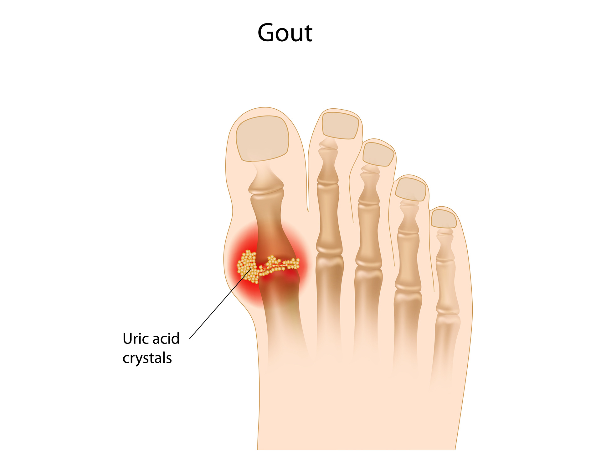 Gout