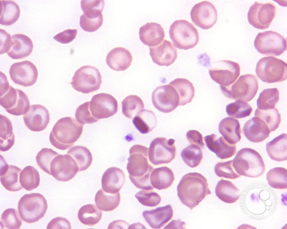 Hemoglobin C Disease