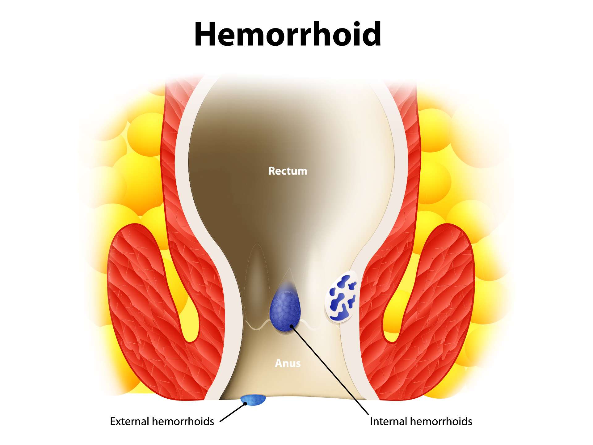 Hemorrhoids