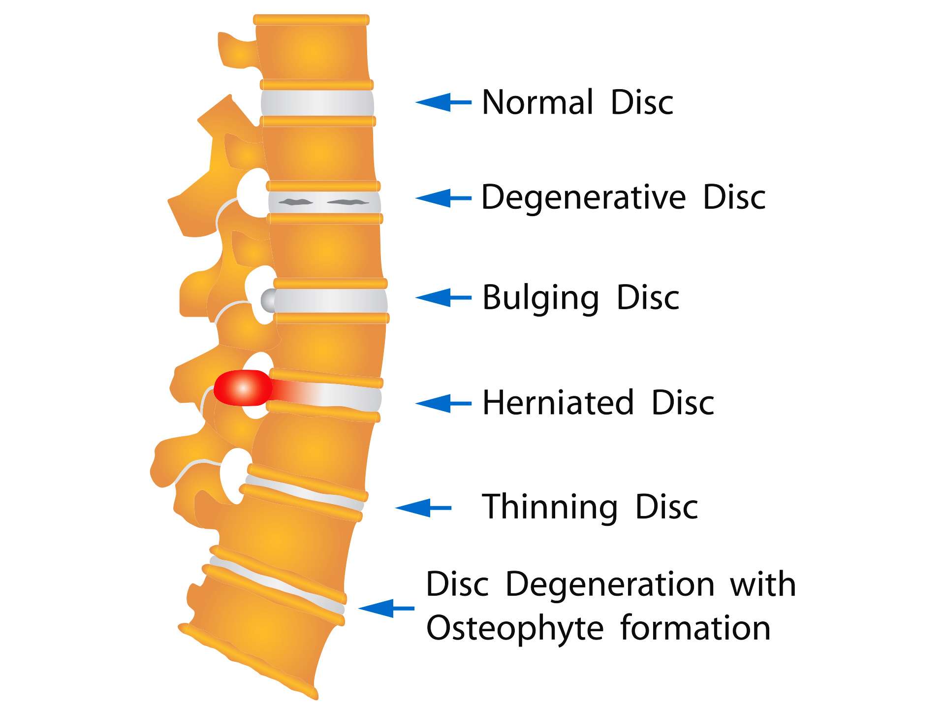 Herniated Disc