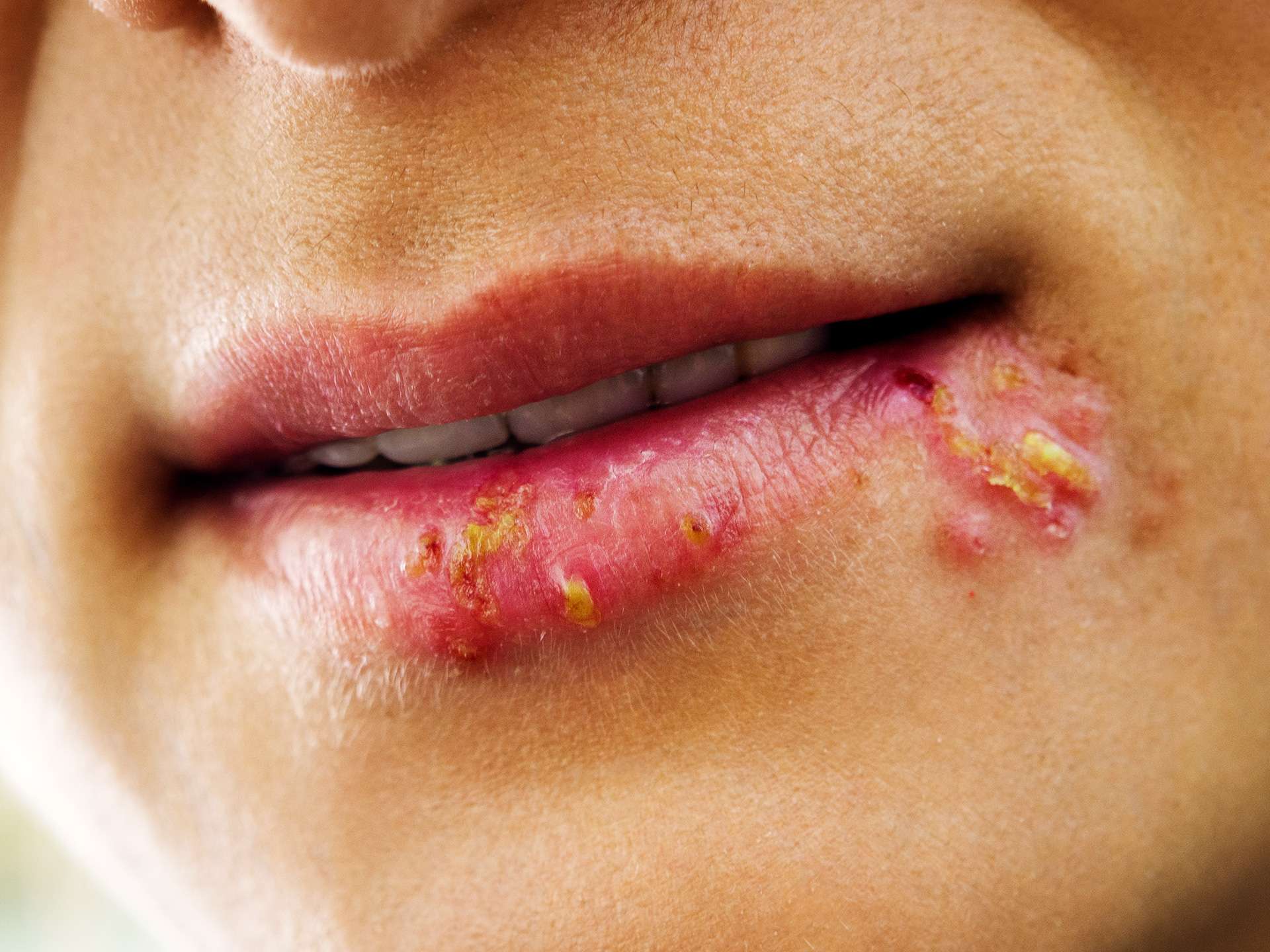 Herpes Simplex