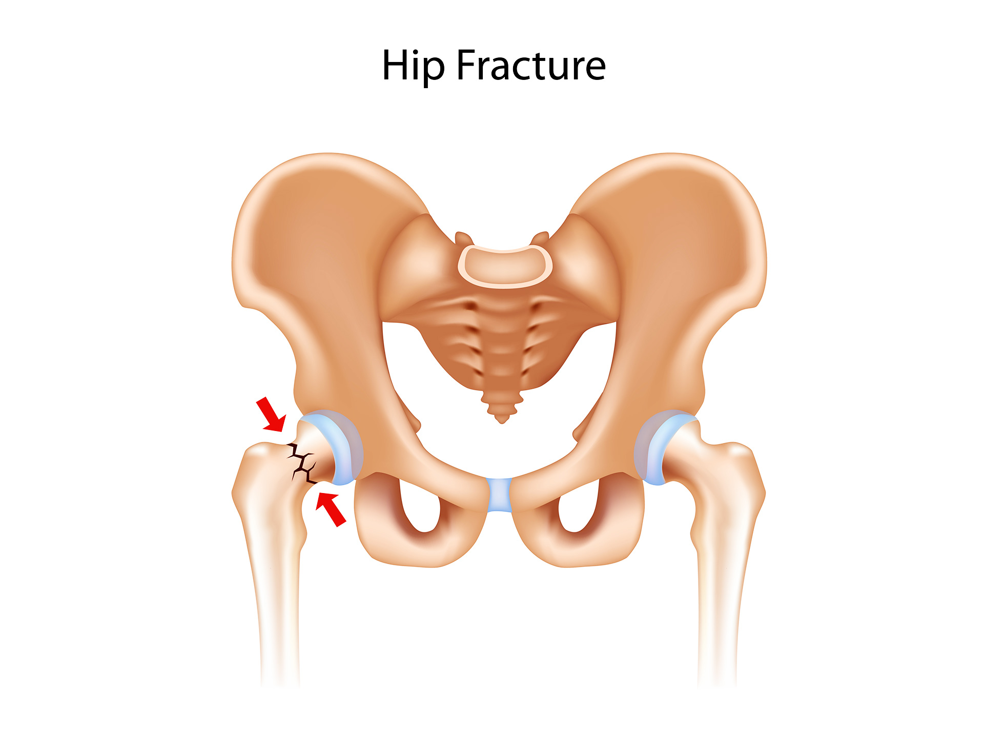 Hip fracture